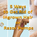 5 Ways to Get Rid of Ingrown Hair or Razor Bumps