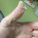 How to Get Rid of Peeling Skin on Hands, Palms and Finger Tips